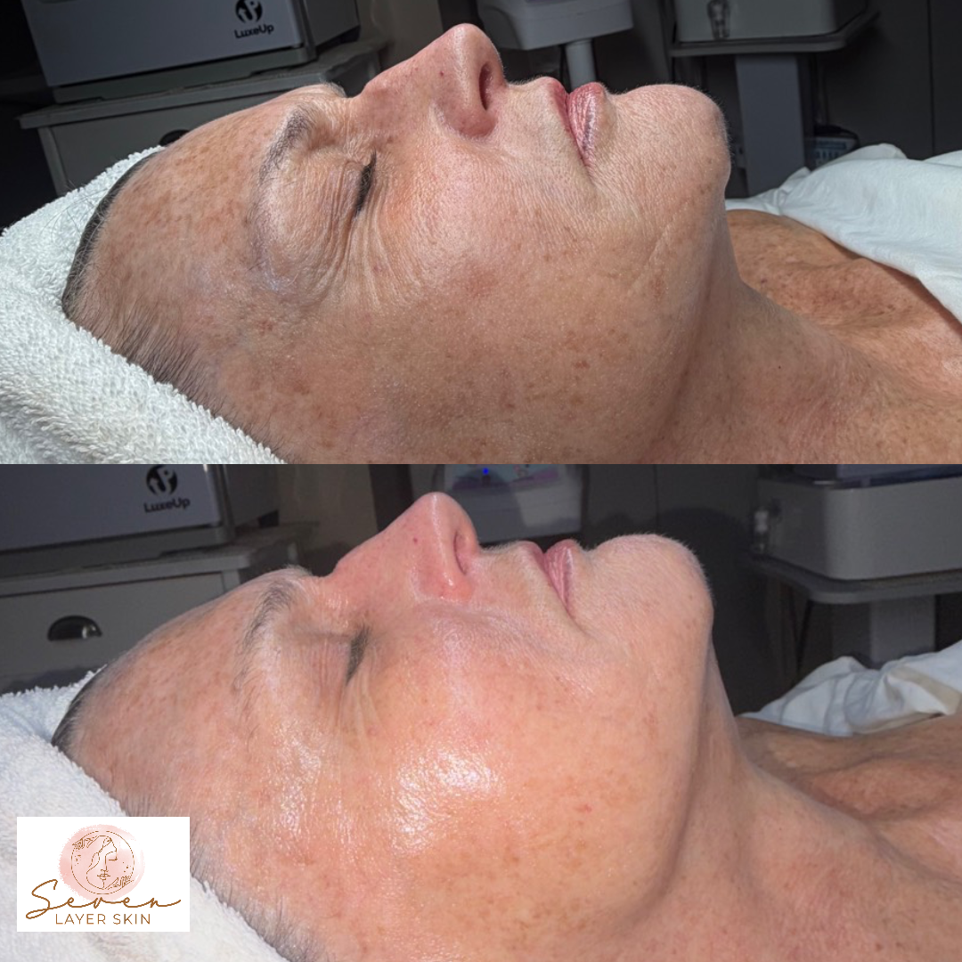 Before and after facial treatment result 2