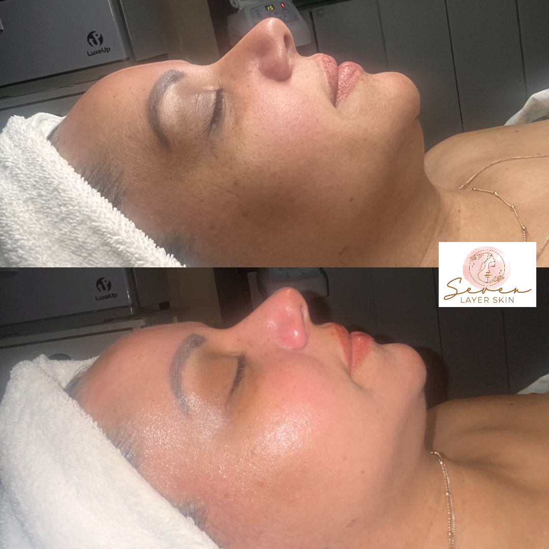 Before and after facial treatment result 5
