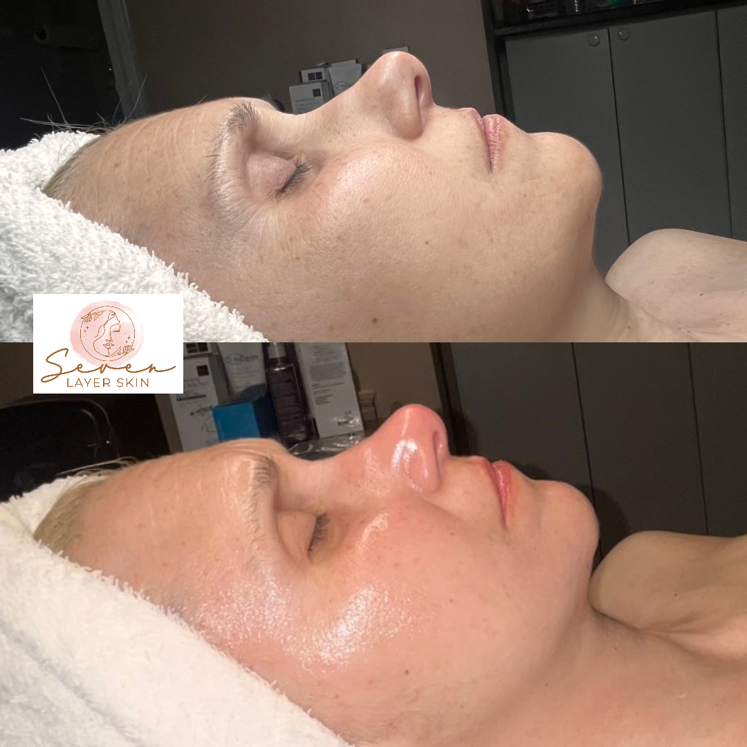Before and after facial treatment result 6