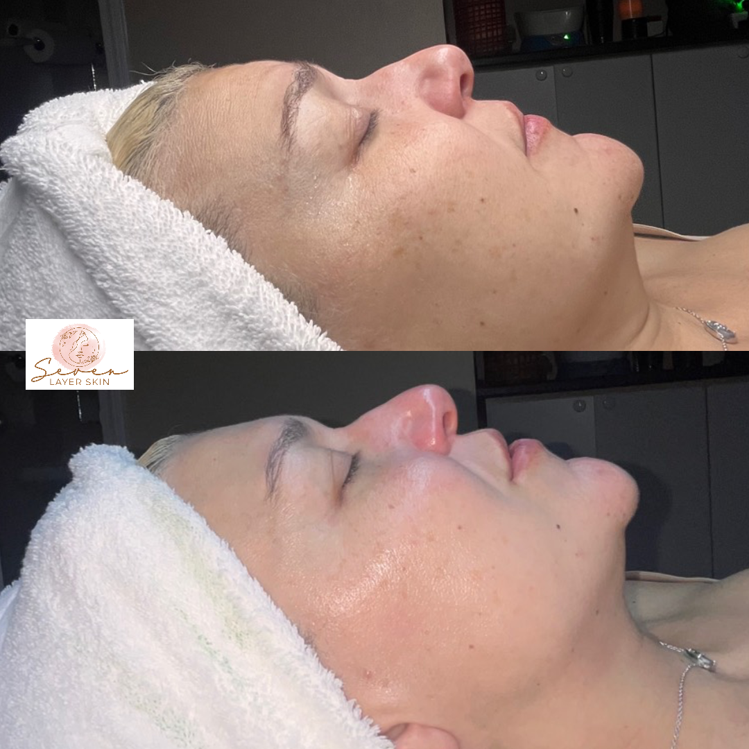 Before and after facial treatment result 7