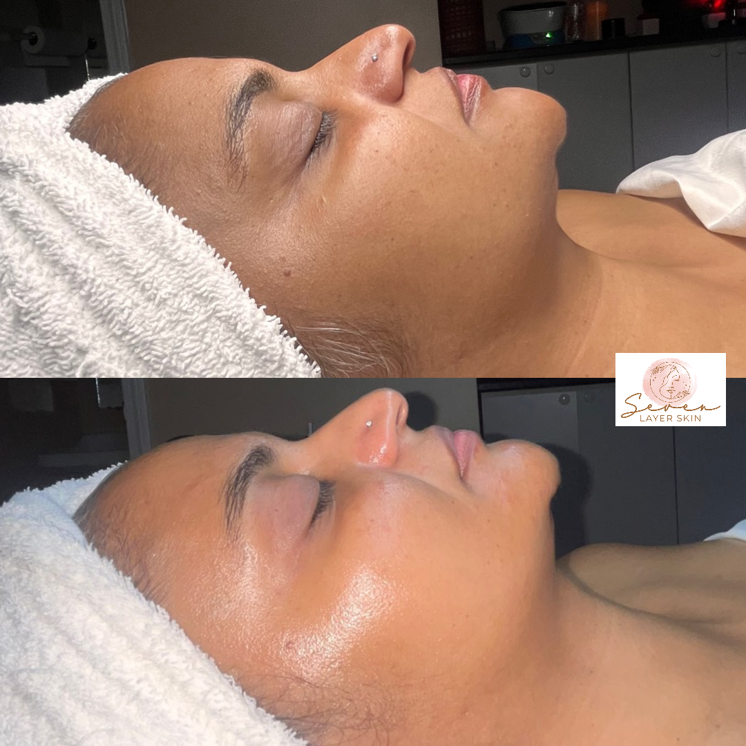 Before and after facial treatment result 8